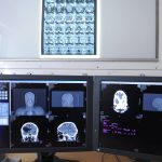 Artificial Intelligence Improving After-Stroke Care