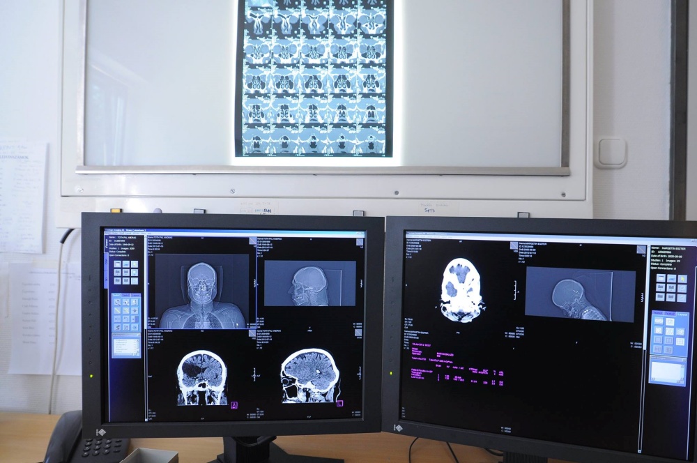 Artificial Intelligence Improving After-Stroke Care post's picture